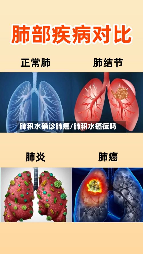 肺积水确诊肺癌/肺积水癌症吗-第1张图片