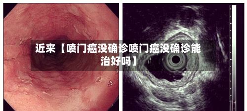 近来【喷门癌没确诊喷门癌没确诊能治好吗】