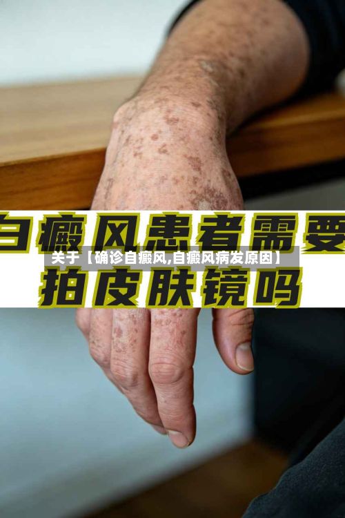 关于【确诊自癜风,自癜风病发原因】-第3张图片