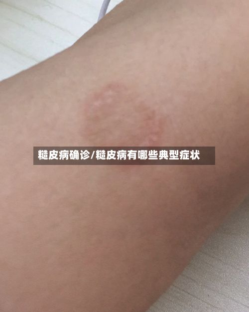 糙皮病确诊/糙皮病有哪些典型症状-第2张图片