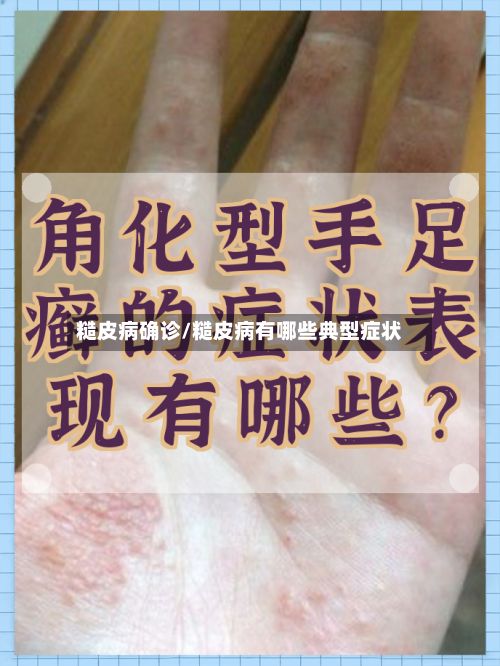 糙皮病确诊/糙皮病有哪些典型症状