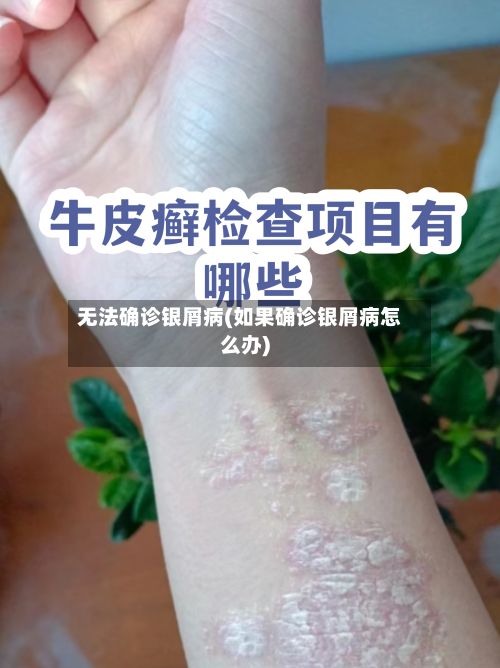 无法确诊银屑病(如果确诊银屑病怎么办)