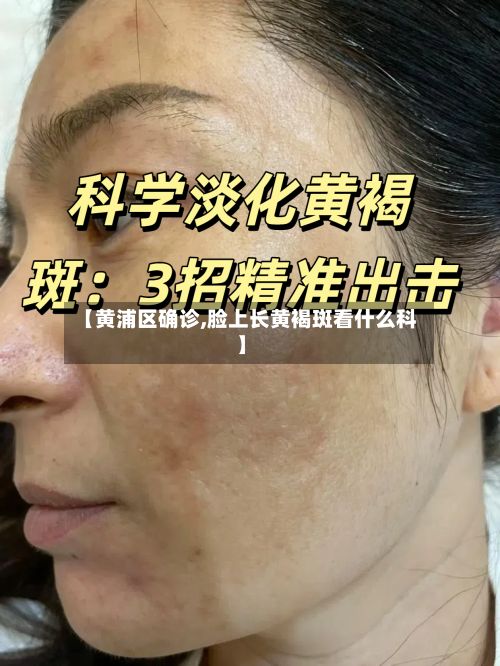 【黄浦区确诊,脸上长黄褐斑看什么科】
