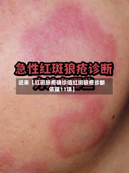 近来【红斑狼疮确诊值红斑狼疮诊断依据11项】