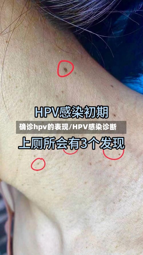 确诊hpv的表现/HPV感染诊断-第3张图片