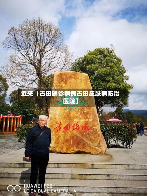 近来【古田确诊病例古田皮肤病防治医院】-第2张图片