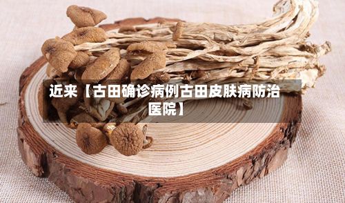 近来【古田确诊病例古田皮肤病防治医院】
