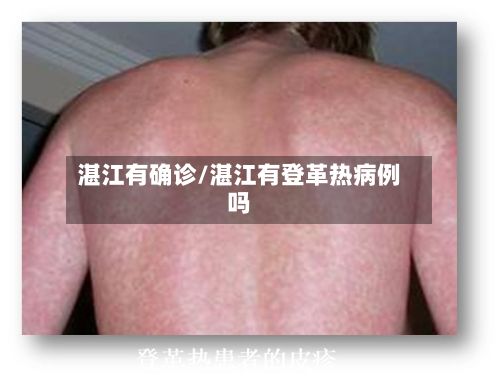 湛江有确诊/湛江有登革热病例吗