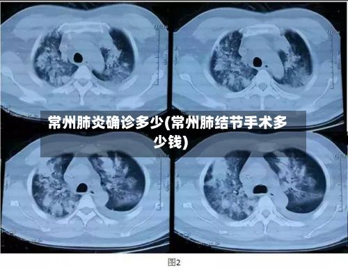 常州肺炎确诊多少(常州肺结节手术多少钱)-第2张图片