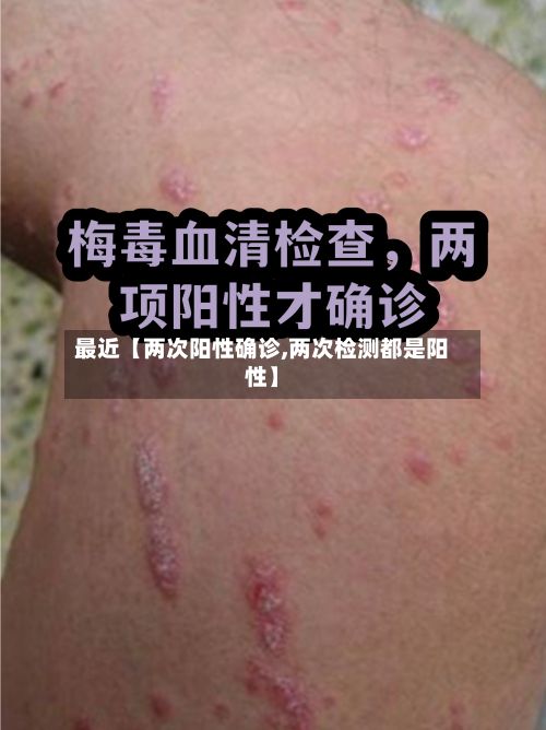 最近【两次阳性确诊,两次检测都是阳性】