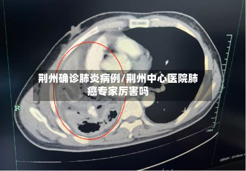 荆州确诊肺炎病例/荆州中心医院肺癌专家厉害吗