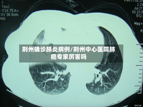 荆州确诊肺炎病例/荆州中心医院肺癌专家厉害吗-第2张图片