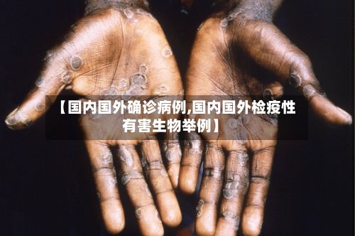 【国内国外确诊病例,国内国外检疫性有害生物举例】
