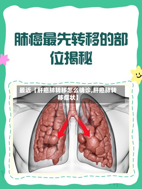 最近【肝癌肺转移怎么确诊,肝癌肺转移症状】